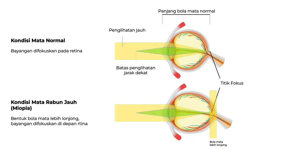 perbedaan kondisi mata normal dengan mata rabun jauh saat melihat sebuah objek